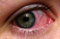 pinkeye