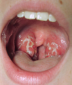 strep