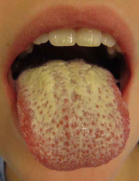 candidaovergrowth