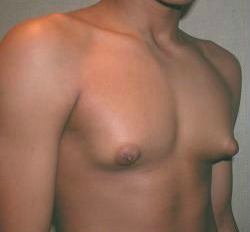 Breast Gay 44