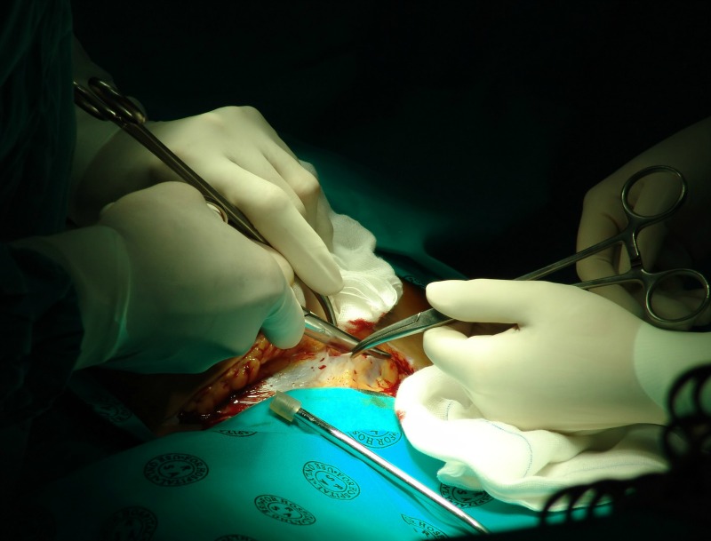 cesarean section