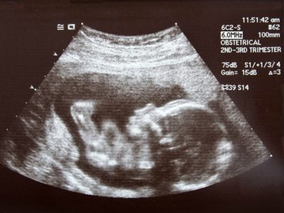 fetal ultrasound