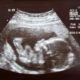 fetal ultrasound