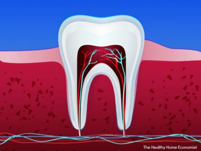 How to Save a Damaged Tooth With No Root Canal