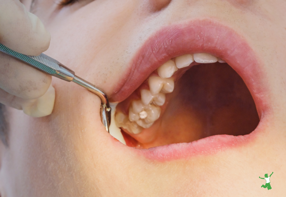vegetarian with a cavity at the dentist
