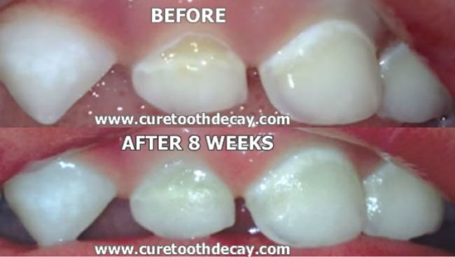 before and after cavity healed