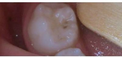 More Photographic Proof Cavities Heal