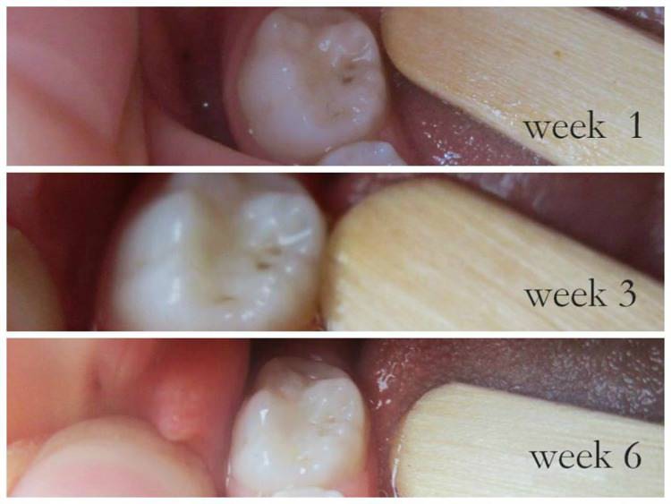 What Do Tooth Cavities Look Like