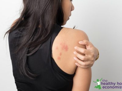 Eczema Treatment: Avoiding the Drug-Based Domino Effect