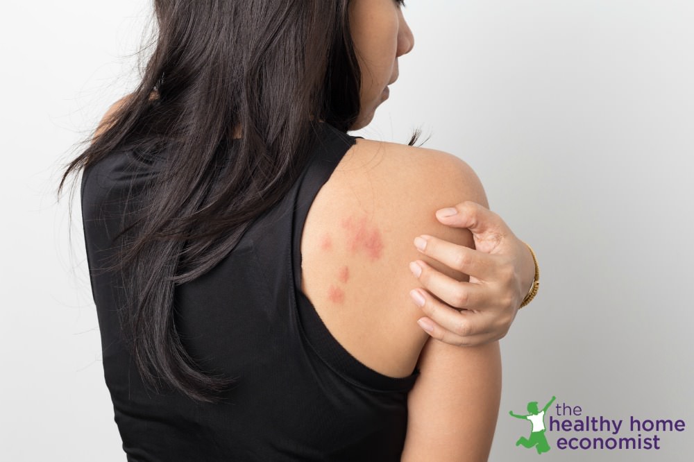 homeopathy for eczema