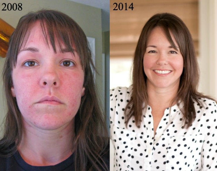 Люди с гипотиреозом. Гипотиреоз лицо до и после. Лицо женщины с гипотиреозом. Болезнь Хашимото до после.