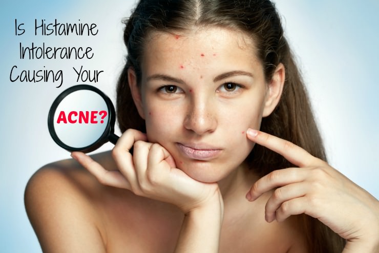 histamine intolerance and acne