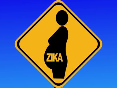 Does Zika Causes Microcephaly?