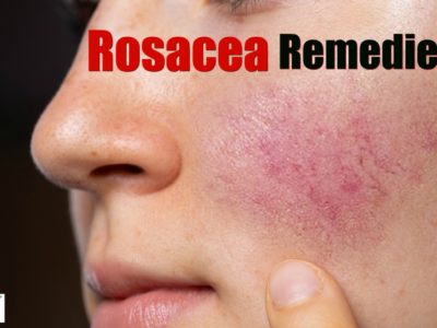 rosacea remedies