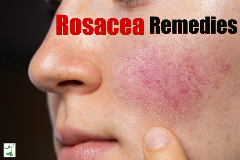 rosacea remedies
