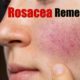 rosacea remedies