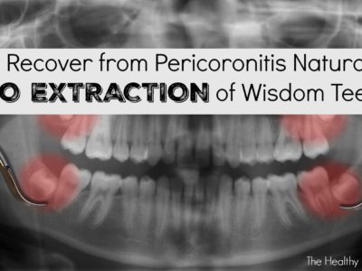 Wisdom Teeth Causing Pericoronitis? How to Avoid Extraction