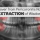 Wisdom Teeth Causing Pericoronitis? How to Avoid Extraction