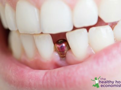 How to Get Dental Implants Without Destroying Your Health