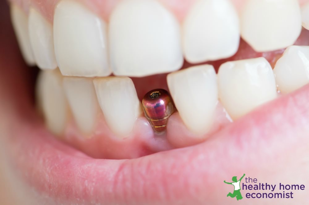 How to Get Dental Implants without Destroying Your Health Healthy