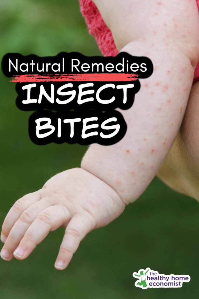 Natural and Effective Insect Bite Remedies Healthy Home Economist