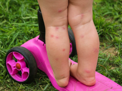 little girl with bug bites on her legs