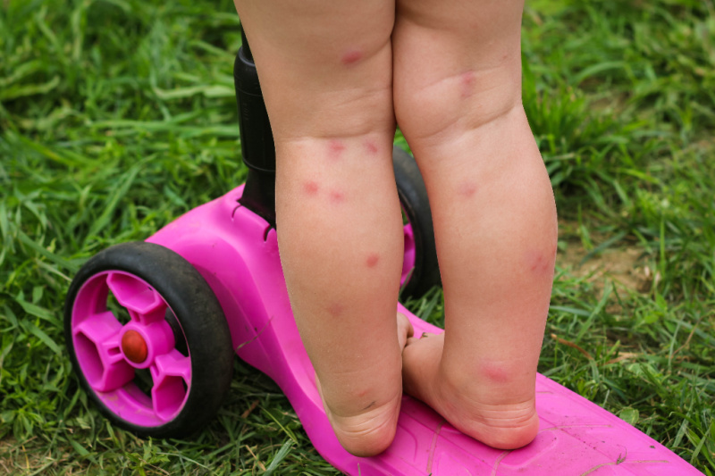little girl with bug bites on her legs