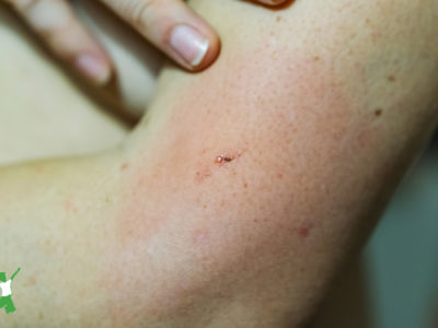 woman with insect bite allergic reaction on her arm