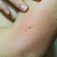 woman with insect bite allergic reaction on her arm