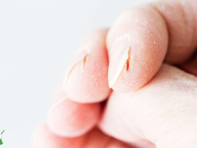 woman with paper cuts on hands