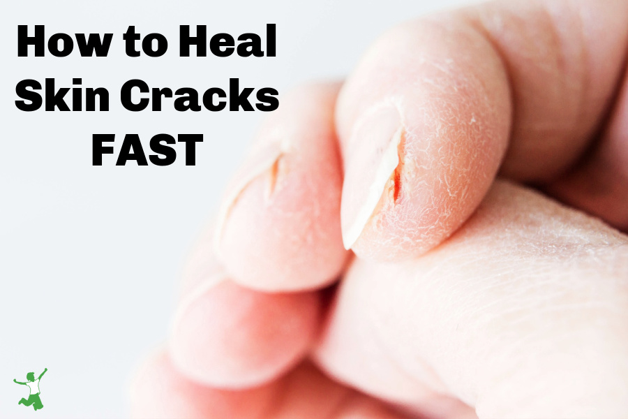 woman with skin cracks and fissures on her fingers