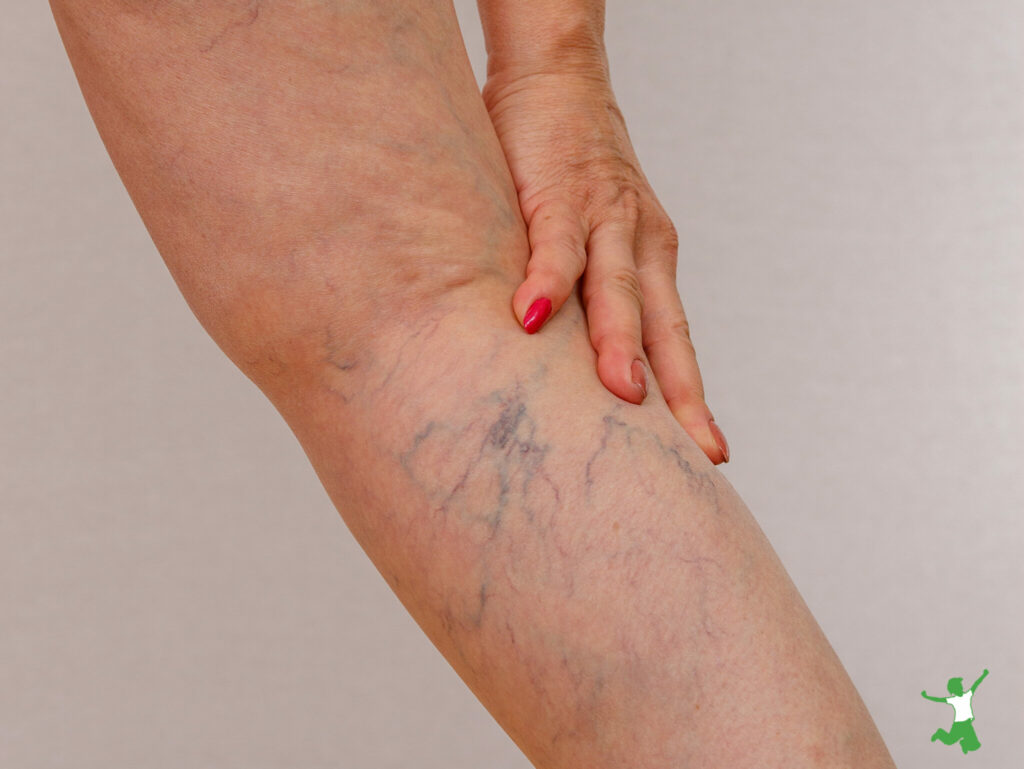 woman using natural treatment for varicose veins in lower right leg