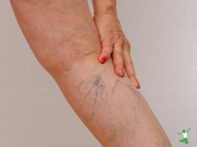 woman with varicose veins in lower right leg