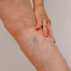 woman with varicose veins in lower right leg