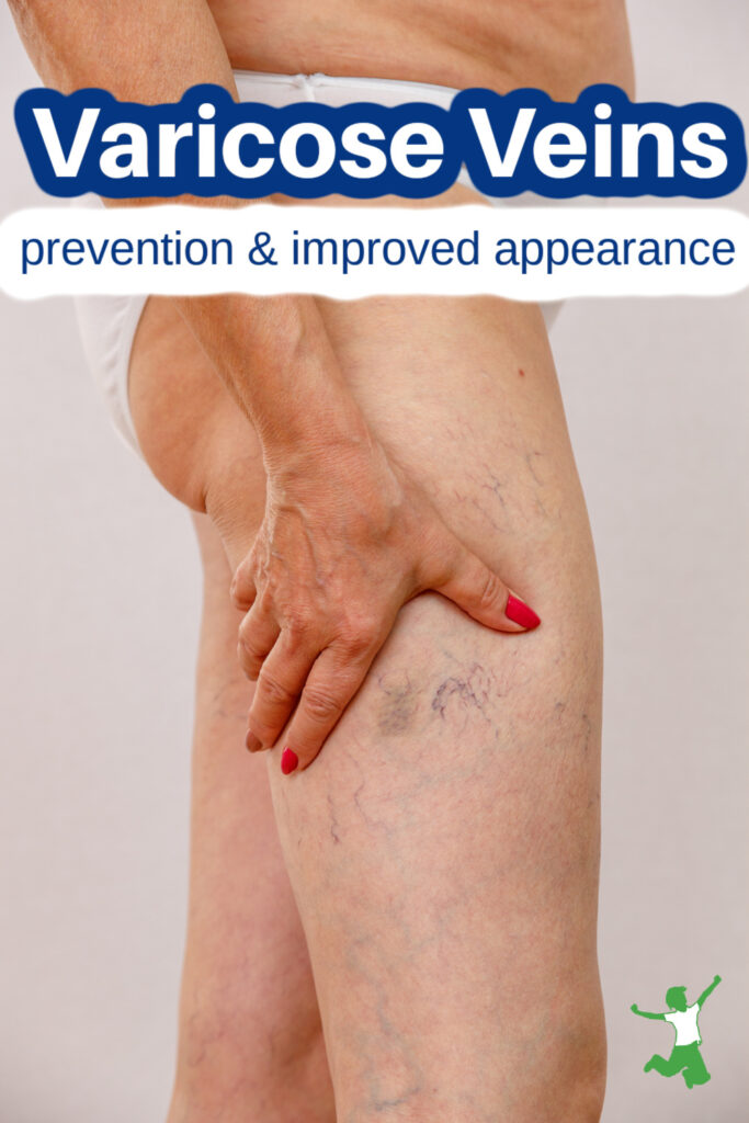 woman improving the appearance of varicose veins