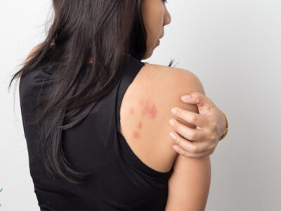 woman with back rash from fermented foods histamine intolerance