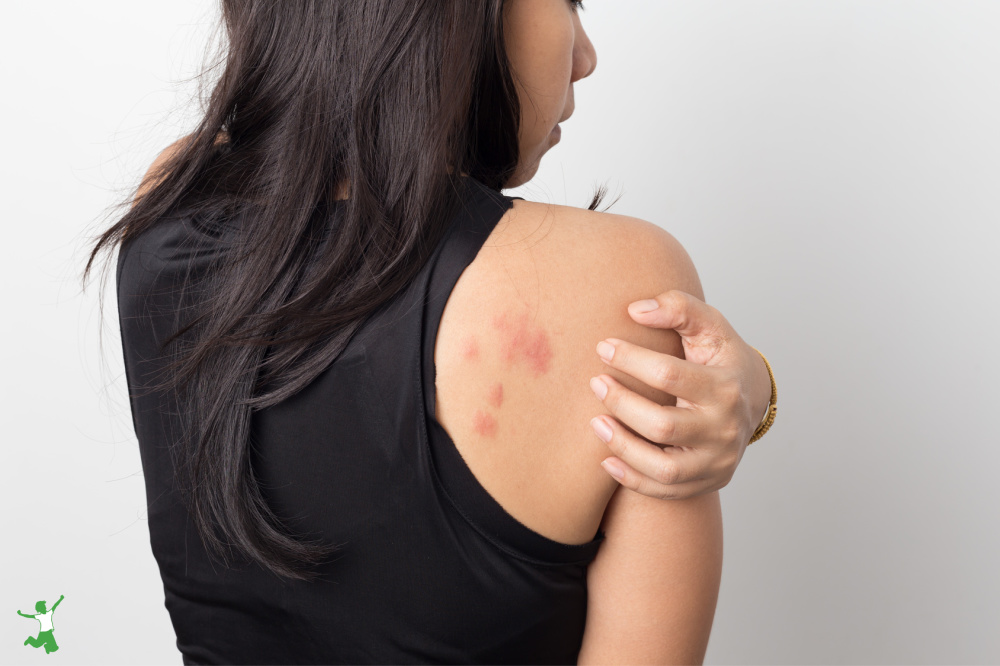 woman with rash on back from histamine intolerance