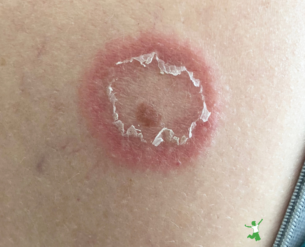 tick bite with red corona on woman's arm needing treatment with natural remedy