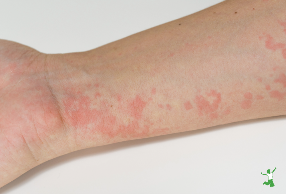 hives child with hives on left lower arm